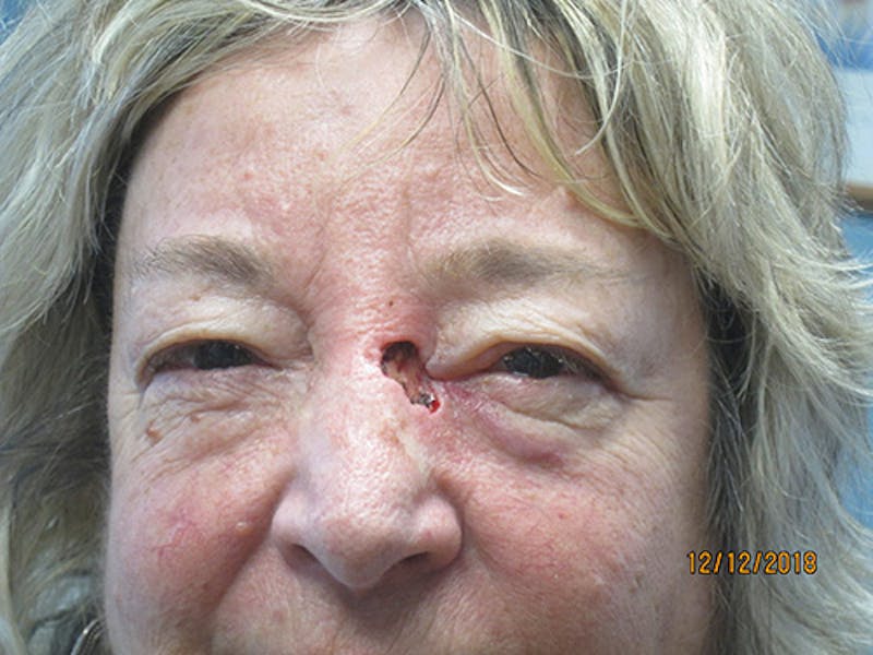 Face Reconstructive Before & After Gallery - Patient 428084 - Image 1