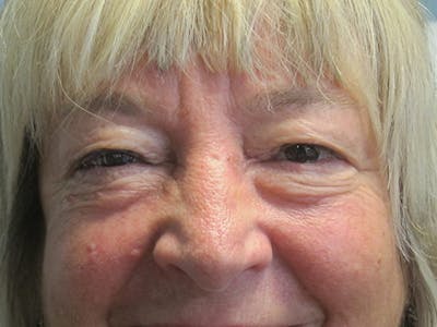Face Reconstructive Before & After Gallery - Patient 428084 - Image 2