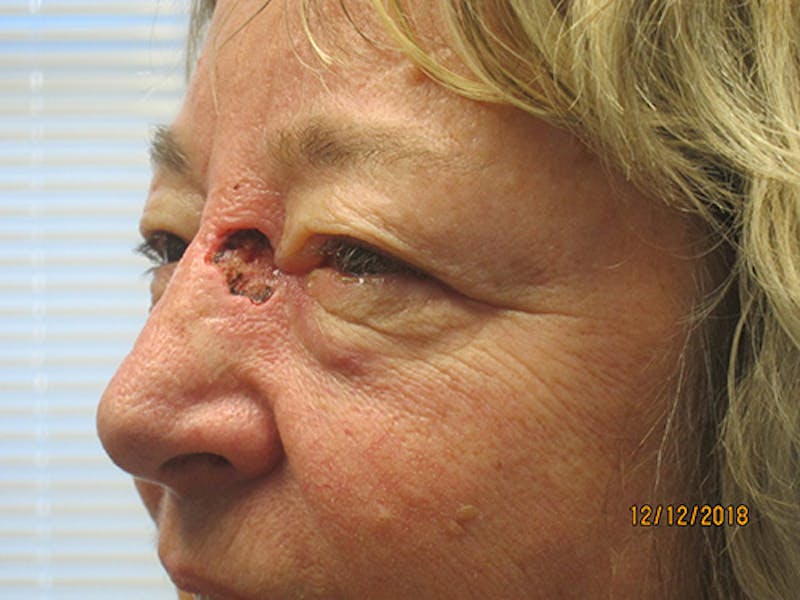 Face Reconstructive Before & After Gallery - Patient 428084 - Image 3