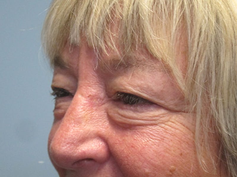Face Reconstructive Before & After Gallery - Patient 428084 - Image 4