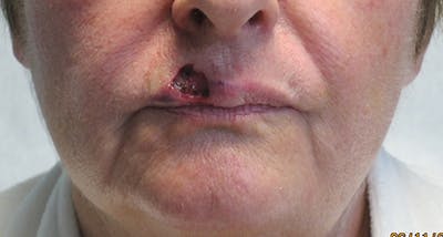 Face Reconstructive Before & After Gallery - Patient 105664 - Image 1
