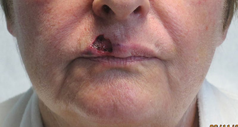 Face Reconstructive Before & After Gallery - Patient 105664 - Image 1