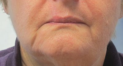 Face Reconstructive Before & After Gallery - Patient 105664 - Image 2