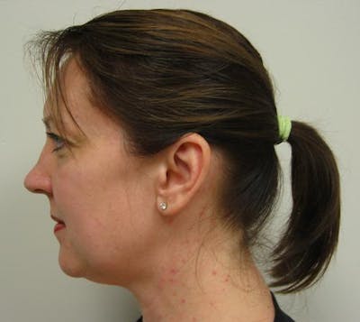 Neck Liposuction Before & After Gallery - Patient 380396 - Image 1