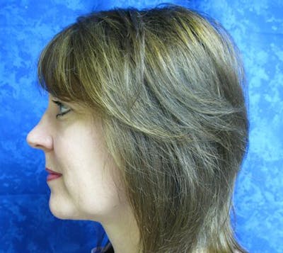 Neck Liposuction Before & After Gallery - Patient 380396 - Image 2