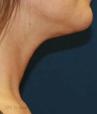 Neck Liposuction Before & After Gallery - Patient 127557 - Image 2