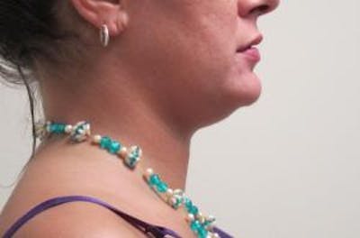 Neck Liposuction Before & After Gallery - Patient 131457 - Image 1
