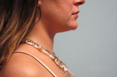 Neck Liposuction Before & After Gallery - Patient 131457 - Image 2