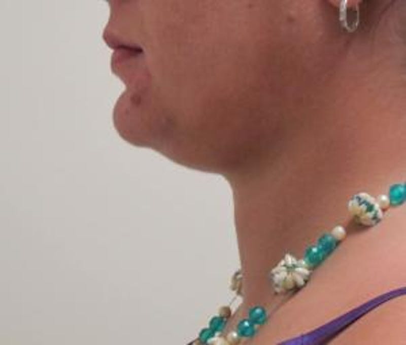 Neck Liposuction Before & After Gallery - Patient 131457 - Image 3
