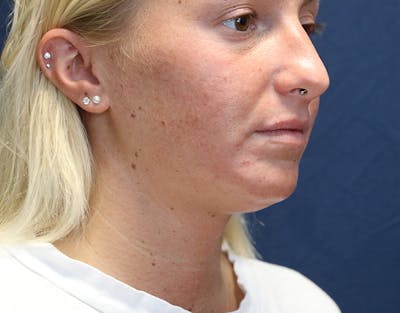Neck Liposuction Before & After Gallery - Patient 317887 - Image 1