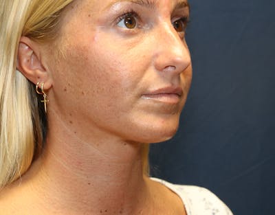 Neck Liposuction Before & After Gallery - Patient 317887 - Image 2