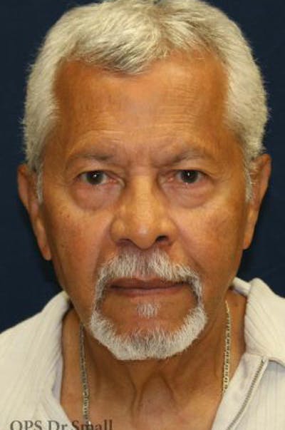 Neck Lift Before & After Gallery - Patient 314273 - Image 1
