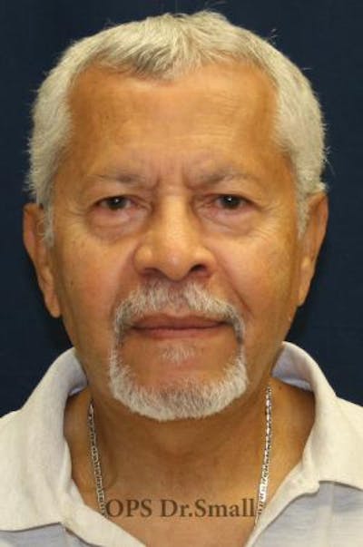 Neck Lift Before & After Gallery - Patient 314273 - Image 2