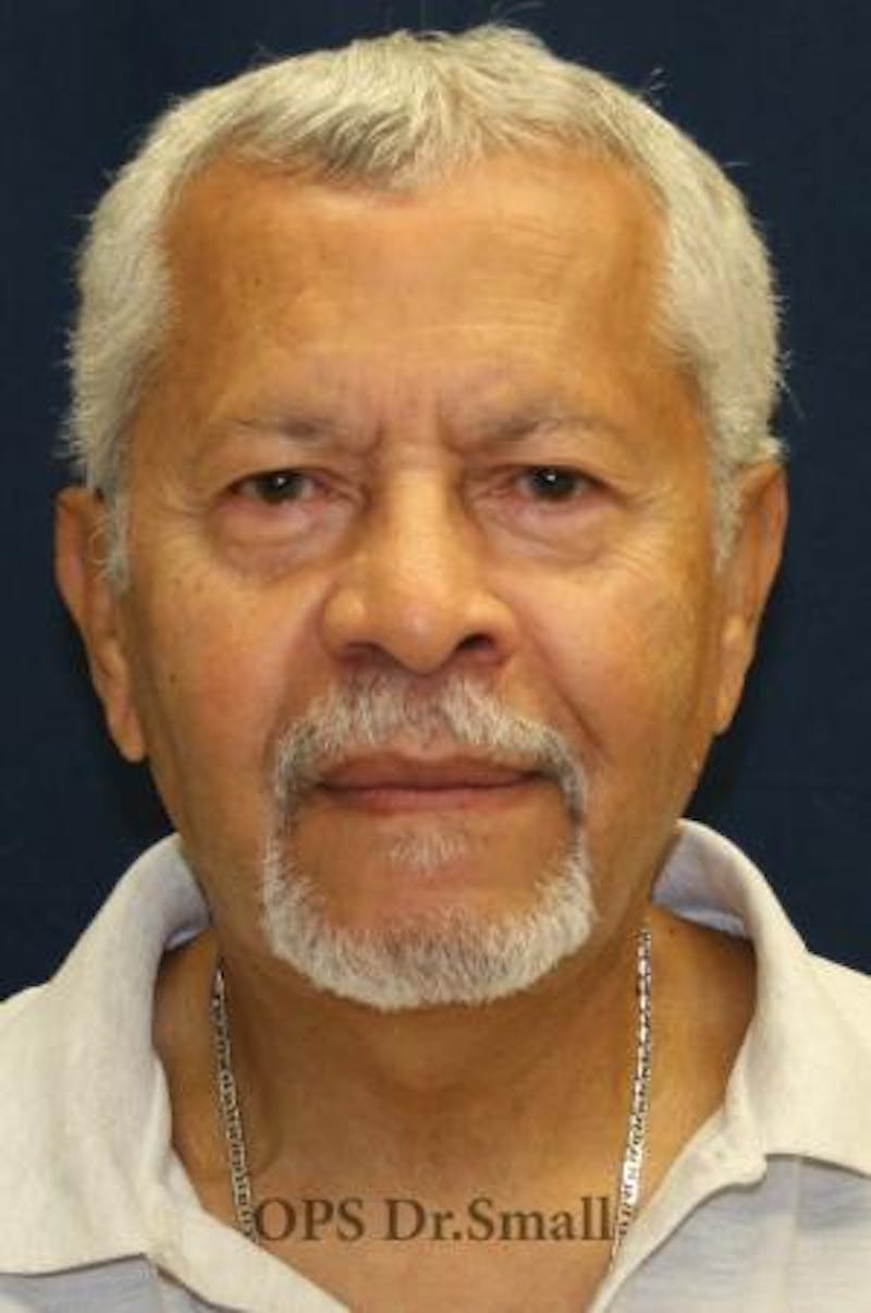 Neck Lift Before & After Gallery - Patient 314273 - Image 2