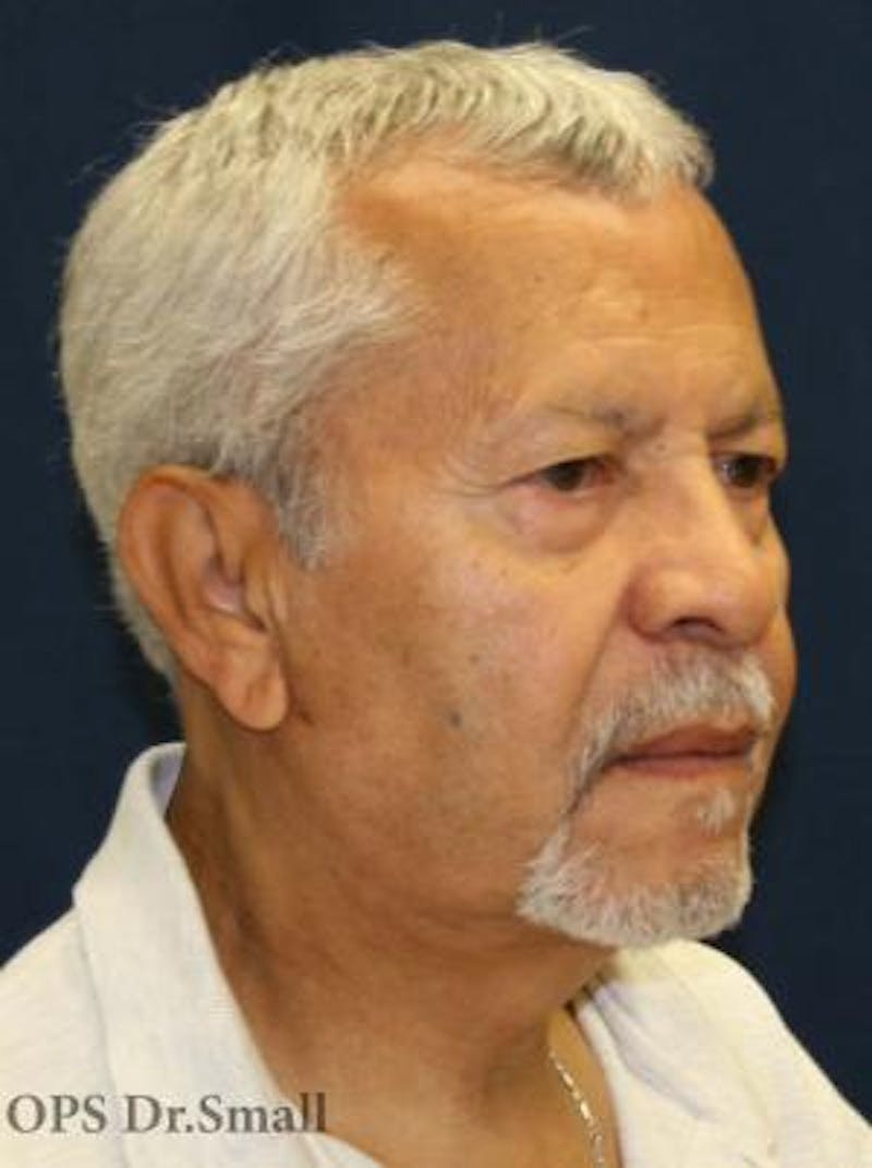 Neck Lift Before & After Gallery - Patient 314273 - Image 4