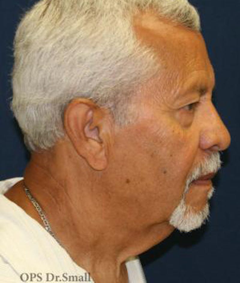 Neck Lift Before & After Gallery - Patient 314273 - Image 5