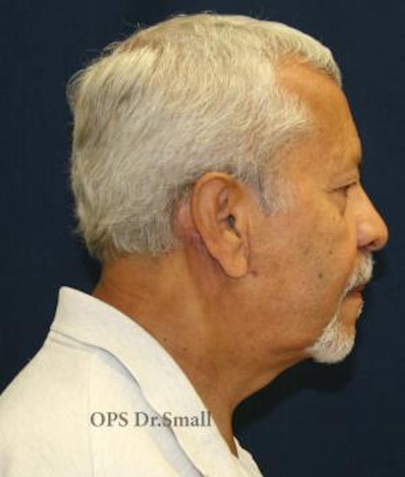Neck Lift Before & After Gallery - Patient 314273 - Image 6
