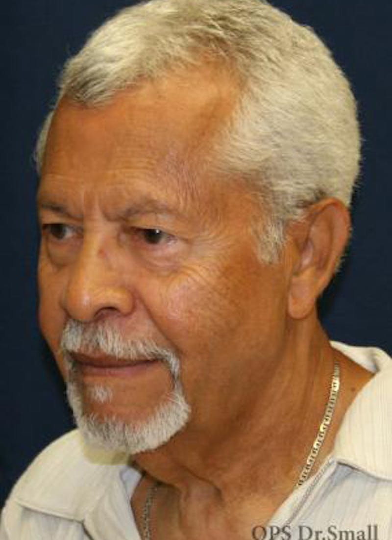 Neck Lift Before & After Gallery - Patient 314273 - Image 7