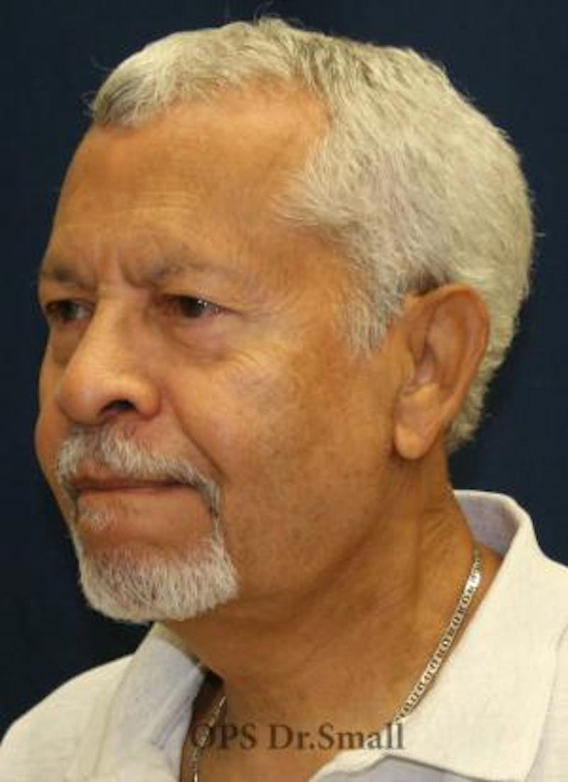 Neck Lift Before & After Gallery - Patient 314273 - Image 8