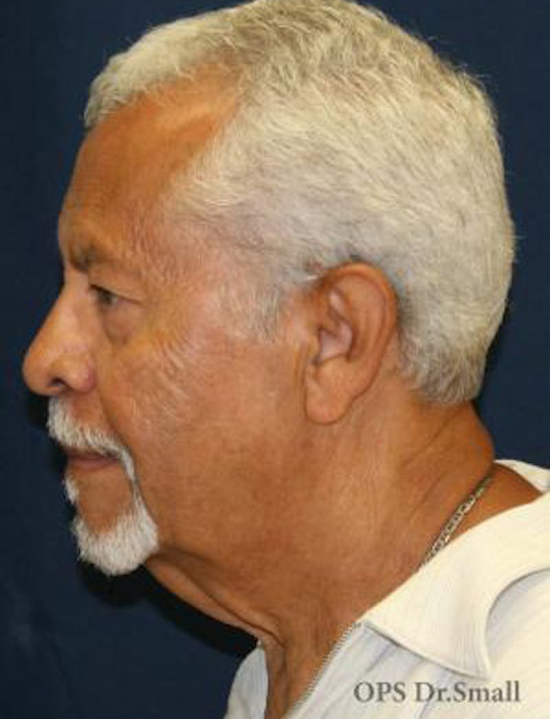 Neck Lift Before & After Gallery - Patient 314273 - Image 9