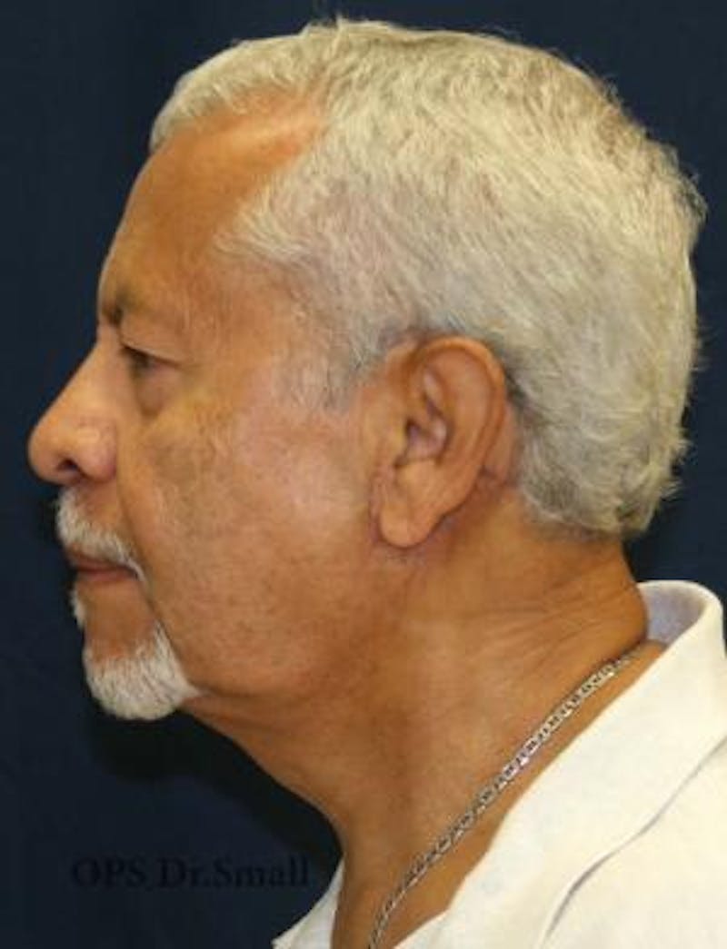 Neck Lift Before & After Gallery - Patient 314273 - Image 10