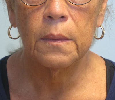 Neck Lift Before & After Gallery - Patient 337074 - Image 1