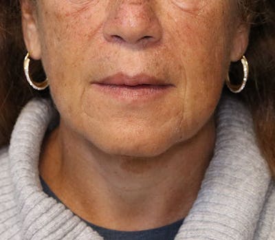 Neck Lift Before & After Gallery - Patient 337074 - Image 2