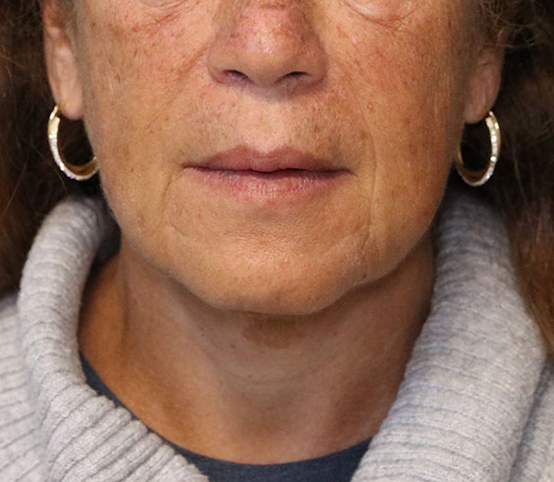 Neck Lift Before & After Gallery - Patient 337074 - Image 2