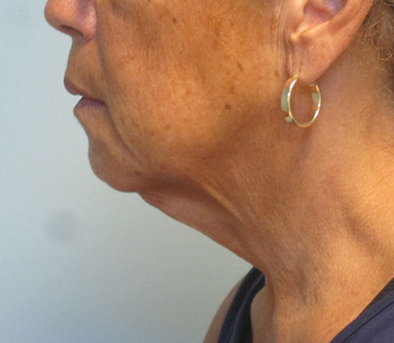 Neck Lift Before & After Gallery - Patient 337074 - Image 3