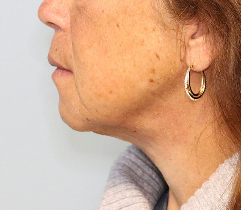 Neck Lift Before & After Gallery - Patient 337074 - Image 4