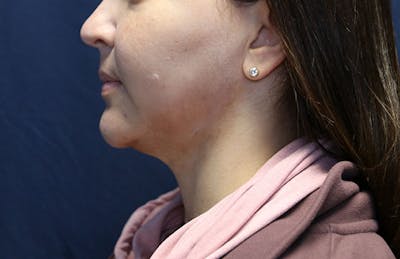 Ellevate Neck Lift Before & After Gallery - Patient 429412 - Image 1