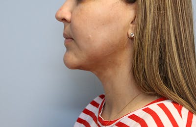 Ellevate Neck Lift Before & After Gallery - Patient 429412 - Image 2