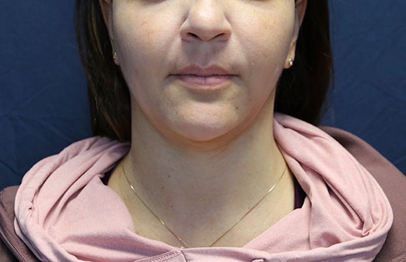 Ellevate Neck Lift Before & After Gallery - Patient 429412 - Image 3