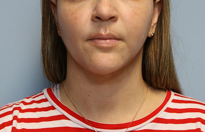 Ellevate Neck Lift Before & After Gallery - Patient 429412 - Image 4