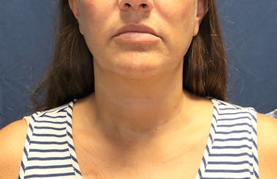 Ellevate Neck Lift Before & After Gallery - Patient 124648 - Image 1