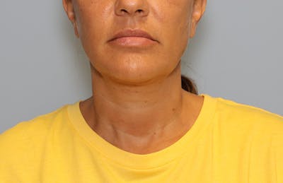Ellevate Neck Lift Before & After Gallery - Patient 124648 - Image 2