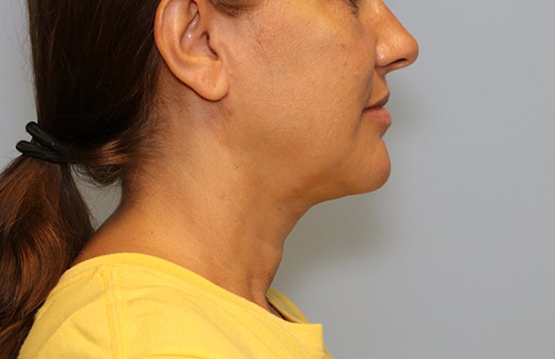Ellevate Neck Lift Before & After Gallery - Patient 124648 - Image 4
