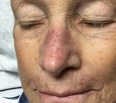 Red/Brown Spot Removal Before & After Gallery - Patient 337995 - Image 1