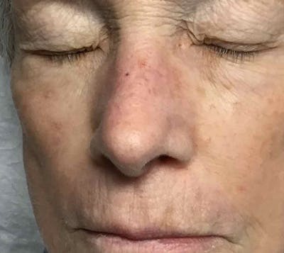 Red/Brown Spot Removal Before & After Gallery - Patient 337995 - Image 2