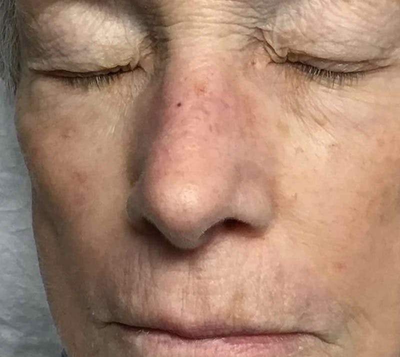 Red/Brown Spot Removal Before & After Gallery - Patient 337995 - Image 2