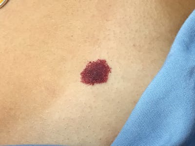 Red/Brown Spot Removal Before & After Gallery - Patient 252151 - Image 1