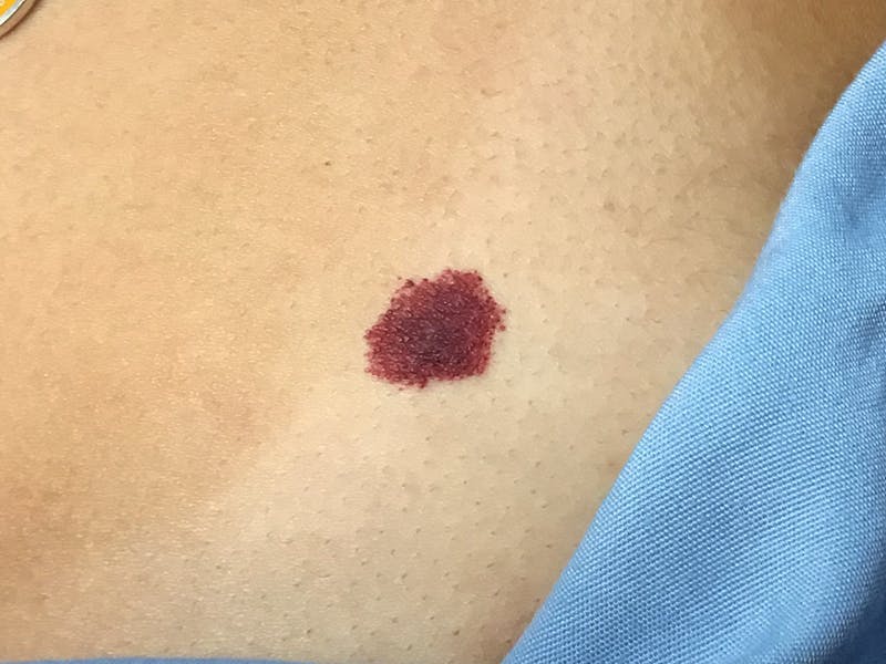 Red/Brown Spot Removal Before & After Gallery - Patient 252151 - Image 1