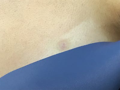 Red/Brown Spot Removal Before & After Gallery - Patient 252151 - Image 2
