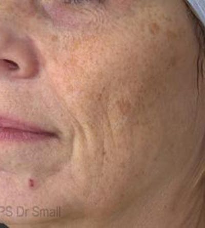 Red/Brown Spot Removal Before & After Gallery - Patient 541712 - Image 1