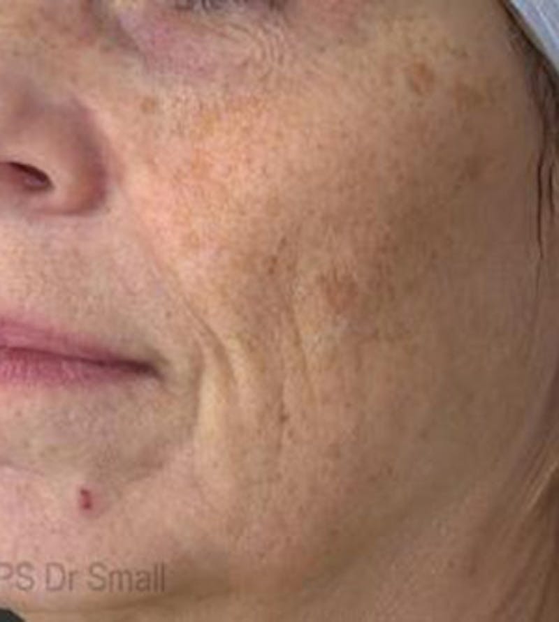 Red/Brown Spot Removal Before & After Gallery - Patient 541712 - Image 1