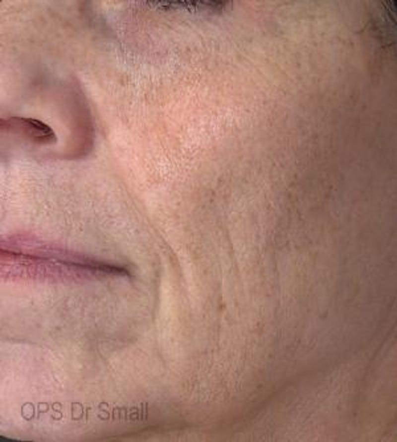 Red/Brown Spot Removal Before & After Gallery - Patient 541712 - Image 2