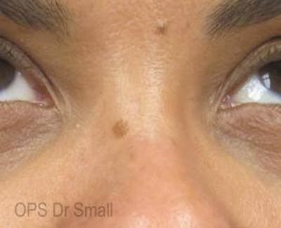 Red/Brown Spot Removal Before & After Gallery - Patient 162735 - Image 1