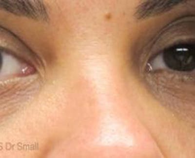 Red/Brown Spot Removal Before & After Gallery - Patient 162735 - Image 2