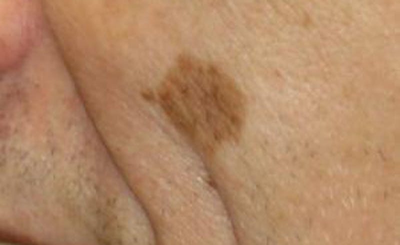 Red/Brown Spot Removal Before & After Gallery - Patient 140129 - Image 1