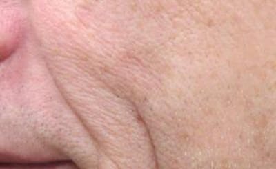 Red/Brown Spot Removal Before & After Gallery - Patient 140129 - Image 2